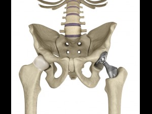 hip replacement implant installed in the pelvis bone 3D Model