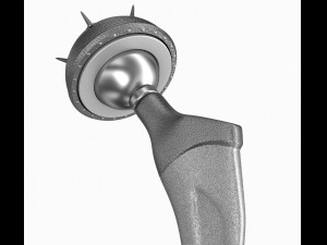 hip replacement implant installed in the pelvis bone 3D Model