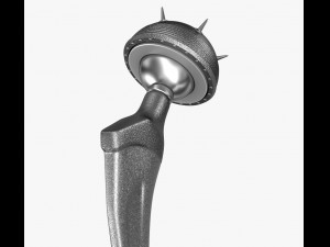 hip replacement implant installed in the pelvis bone 3D Model