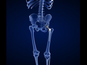 hip replacement implant installed in the pelvis bone 3D Model