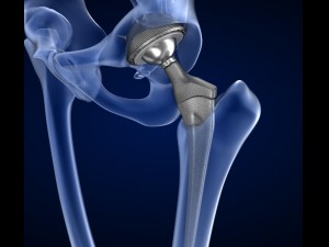 hip replacement implant installed in the pelvis bone 3D Model