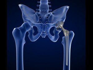 hip replacement implant installed in the pelvis bone 3D Model