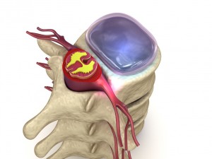 hernaited disc in human spine in details 3D मॉडल
