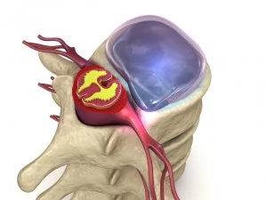 hernaited disc in human spine in details 3D Model