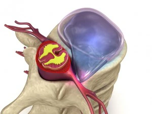 hernaited disc in human spine in details 3D Model