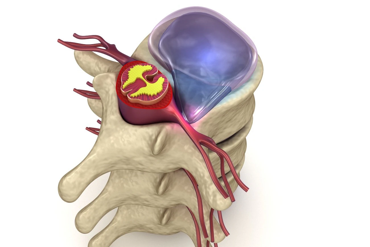 hernaited disc in human spine in details 3D Model .c4d .max .obj .3ds .fbx .stl .blend 