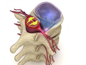 ernia del disco nella colonna vertebrale umana in dettaglio Modello 3D