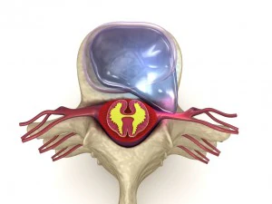 hernaited disc in human spine in details 3D Model