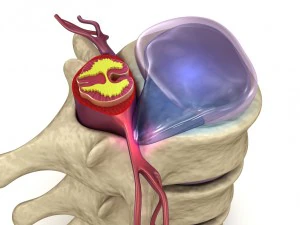 hernaited disc in human spine in details 3D Model