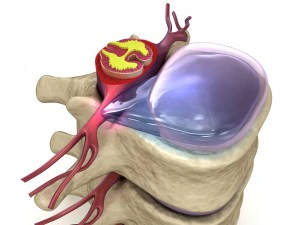 hernaited disc in human spine in details 3D Model