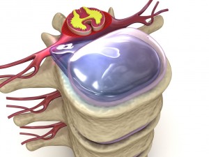 hernaited disc in human spine in details 3D मॉडल