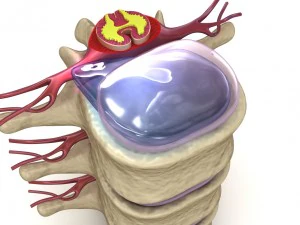hernaited disc in human spine in details 3D Model
