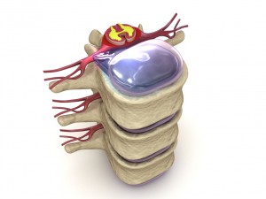 hernaited disc in human spine in details 3D मॉडल