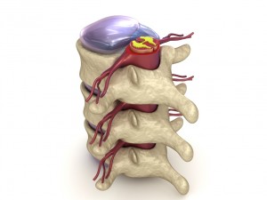 hernaited disc in human spine in details 3D मॉडल