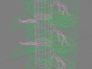 hernaited disc in human spine in details 3D Model