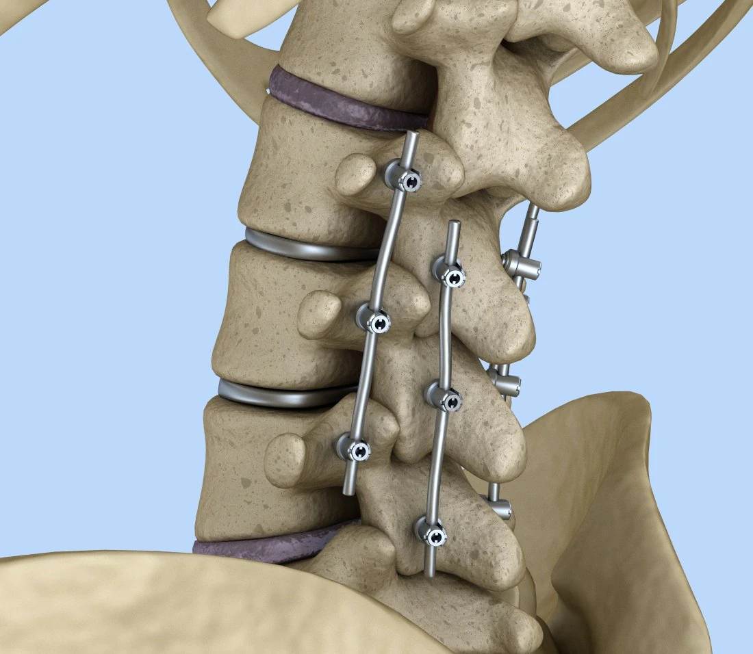 spinal fixation system - titanium bracket 3D Model .c4d .max .obj .3ds .fbx .stl .blend 