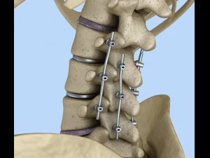sistema de fixa&ccedil;&atilde;o espinhal - suporte de tit&acirc;nio Modelo 3D