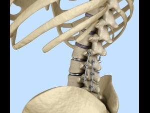 spinal fixation system - titanium bracket 3D 모델