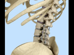 spinal fixation system - titanium bracket 3D Model