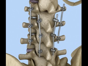 spinal fixation system - titanium bracket 3D 모델