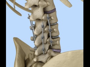 spinal fixation system - titanium bracket 3D 모델