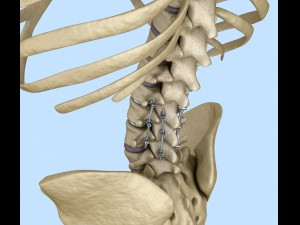 spinal fixation system - titanium bracket 3D 모델