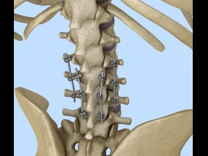 spinal fixation system - titanium bracket 3D 모델