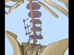 spinal fixation system - titanium bracket 3D 모델