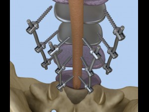 spinal fixation system - titanium bracket 3D 모델