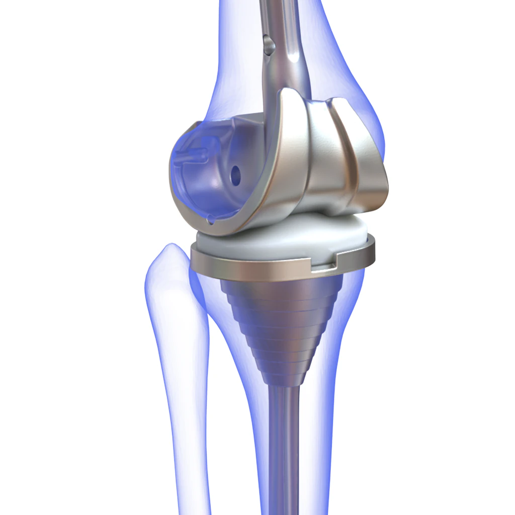 Knee Replacement Implant 3D Model .c4d .max .obj .3ds .fbx .stl .blend 