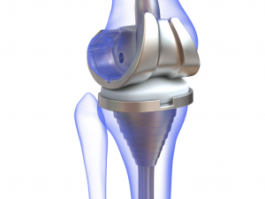 Knee Replacement Implant 3D Model