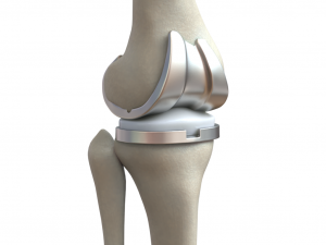 Knee Replacement Implant 3D-Modell