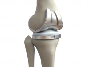 Knee Replacement Implant 3D Model