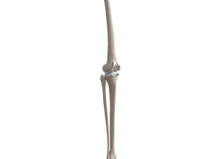 Knee Replacement Implant 3D Model