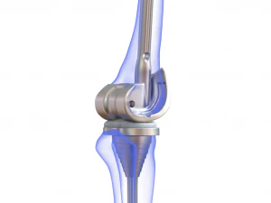 Knee Replacement Implant 3D Model