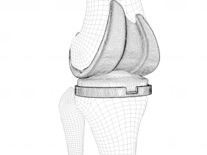 Knee Replacement Implant 3D Model
