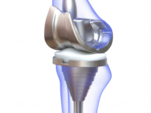 Knee Replacement Implant 3D-Modell