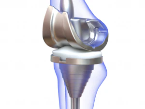 Knee Replacement Implant 3D Model