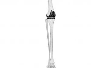 Knee Replacement Implant 3D Model