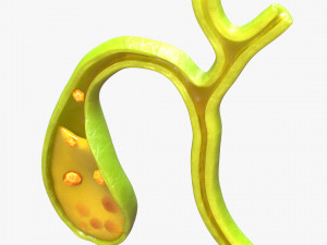 Gallbladder With Gallstones 3D Modell