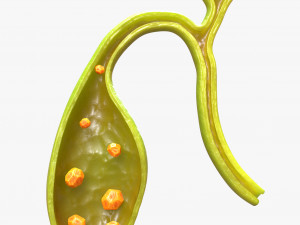 Gallbladder With Gallstones 3D Modell