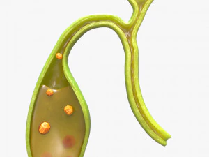 Gallbladder With Gallstones 3D Model