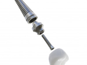 Dental Implant Animation 3D Model