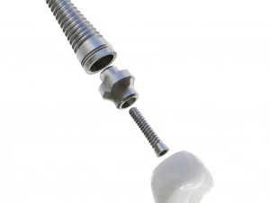 Dental Implant Animation 3D Model
