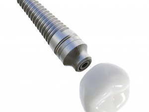 Dental Implant Animation 3D Model