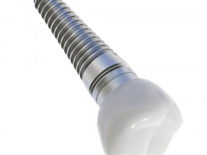 Dental Implant Animation 3D Model