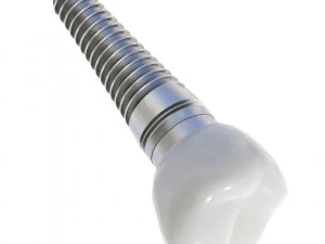 Dental Implant Animation 3D Model