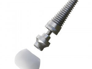 Dental Implant Animation 3D Model