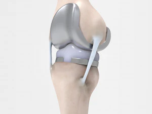 膝関節置換術 3Dモデル