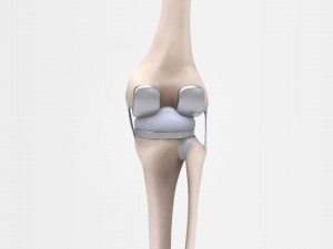 Knee Replacement Modello 3D